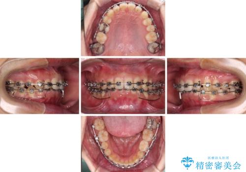 【モニター】前歯に隙間ができるほどのディープバイト　ワイヤー装置で負担の少ない咬み合わせにの治療中