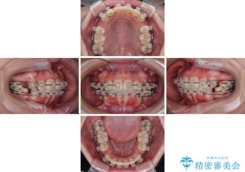 唇からはみ出るほど飛び出した前歯 ワイヤー装置による抜歯矯正の治療中
