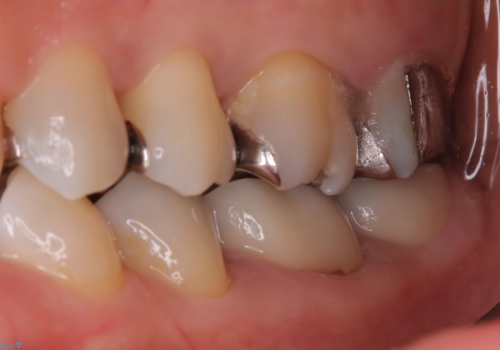詰め物と歯の境目に穴が空いているの治療前