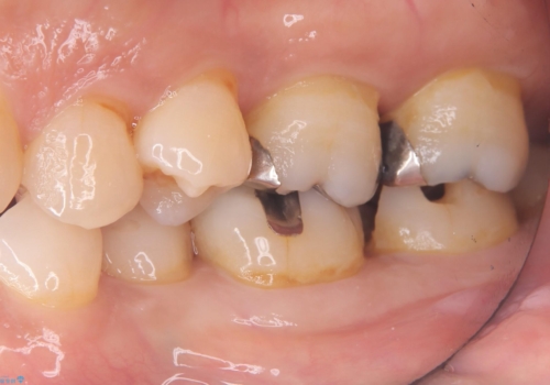 【セラミックインレー】詰め物が外れた 白くしたいの治療前