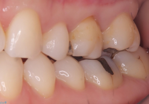 【セラミックインレー】詰め物と歯の境目に汚れが溜まるの治療前
