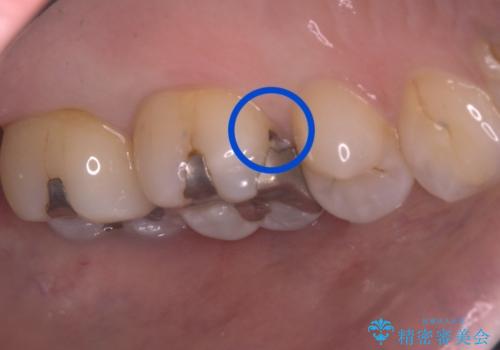 【セラミックインレー】詰め物と歯の境目に汚れが溜まるの治療前