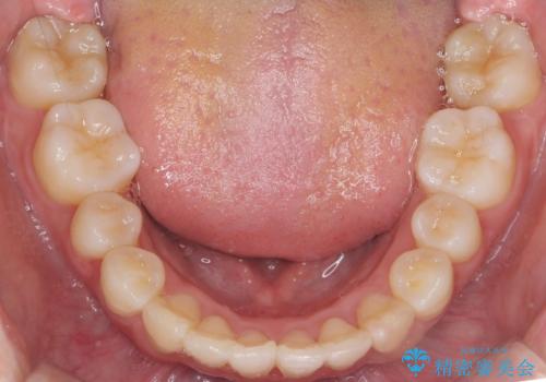 難症例 奥歯がかみ合っていない 歯並び矯正で別人にの治療後