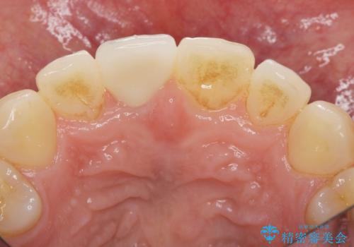 前歯の変色　打撲により失活した前歯の根管・セラミック治療の治療後