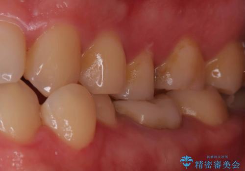 【ハイブリッドインレー】定期検診で見つかった虫歯!の治療前