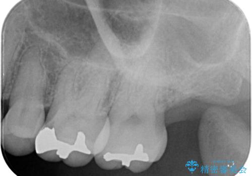 【セラミックインレー】詰め物と歯の境目に汚れが溜まるの治療前