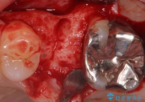 歯茎が腫れる　インプラントでの治療の治療中