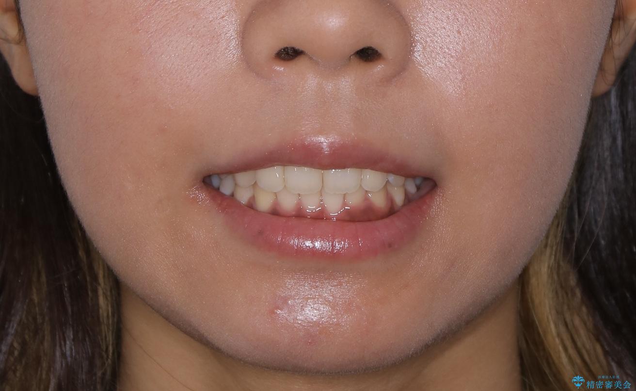 インビザライン矯正 歯を抜かずに出っ歯を改善!の治療後(顔貌)