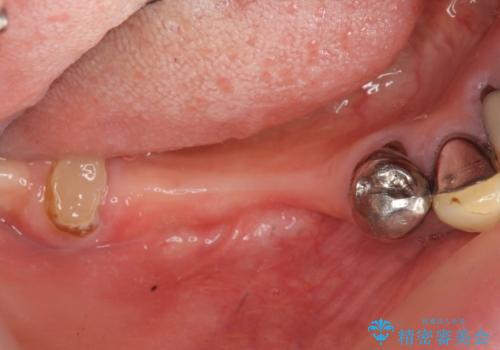 狭小な歯槽骨に対するインプラント治療の治療前