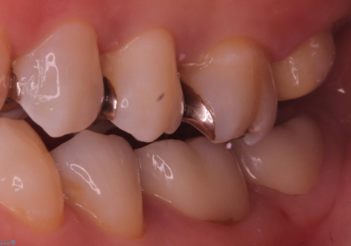 詰め物と歯の境目に穴が空いているの治療中