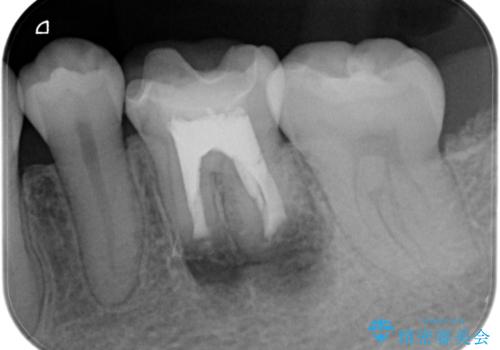 【歯根端切除術】根っこの先端の病気が治らないの治療中