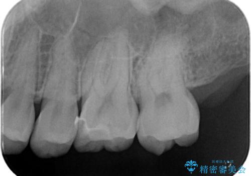 【ハイブリッドインレー】定期検診で見つかった虫歯!の治療後