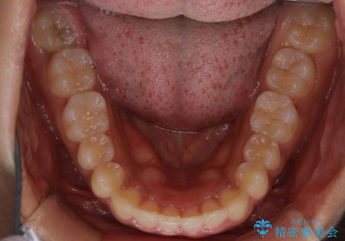 インビザライン矯正 歯を抜かずに出っ歯を改善!の治療後