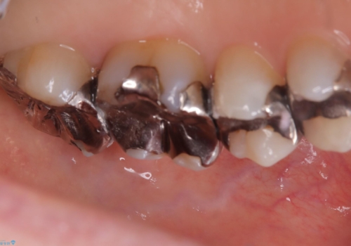 詰め物と歯の境目に穴が空いているの治療前