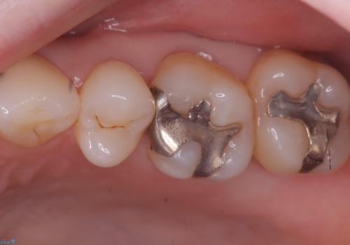詰め物と歯の境目に汚れが溜まるの症例 治療前