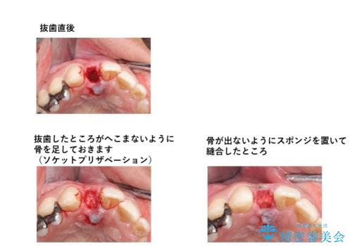 前歯をやむなく抜歯 ブリッジに 治療ついでに歯並びもよくの治療中
