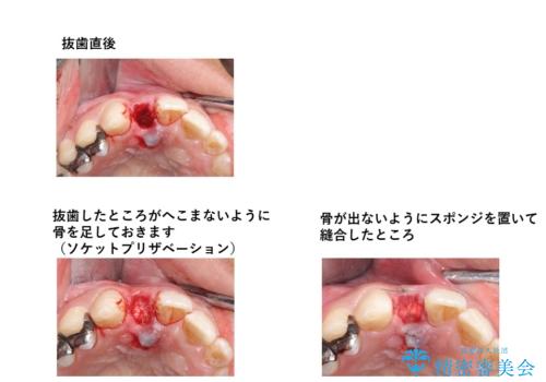 前歯をやむなく抜歯　ブリッジに　治療ついでに歯並びもよくの治療中