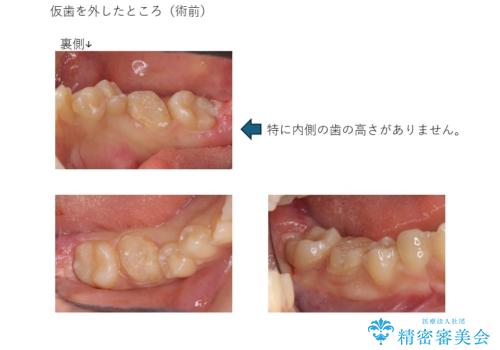 奥歯の高さがない 歯周外科処置で解決 (クラウンレングスニング)の治療前