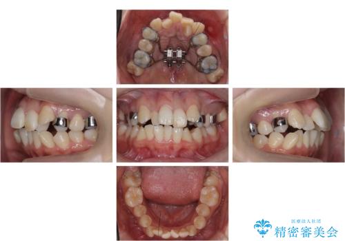 難症例　奥歯がかみ合っていない　歯並び矯正で別人にの治療中