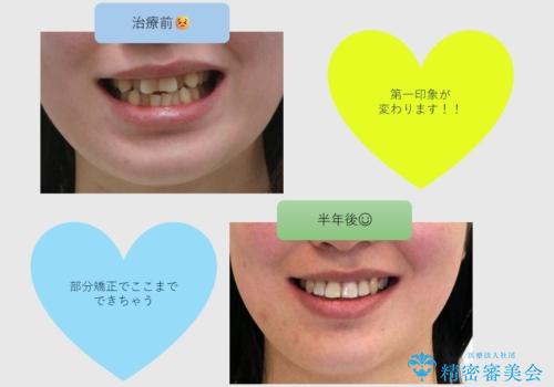 前歯のがたつき、中に入ってしまっている 部分矯正で低予算で
