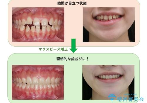 人の印象は歯並びから! 実は…美容医療より効果抜群!! コスパ重視ならすきっ歯の矯正治療