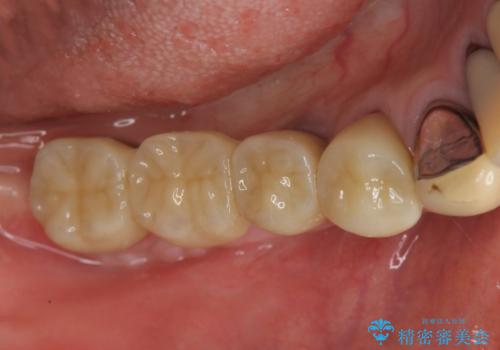 狭小な歯槽骨に対するインプラント治療の治療後