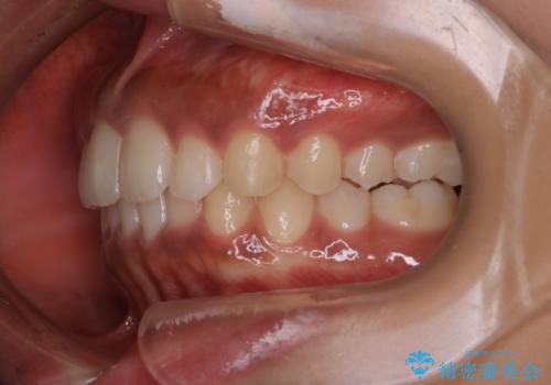 インビザライン矯正　歯を抜かずに出っ歯を改善!の治療後