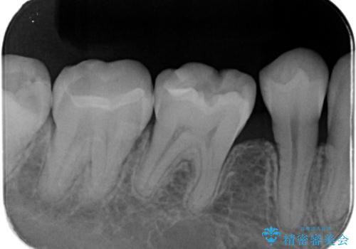【セラミックインレー】プラスチックの詰め物をセラミックにしたいの治療後