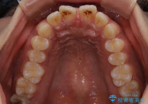 インビザライン矯正 歯を抜かずに出っ歯を改善!の治療前