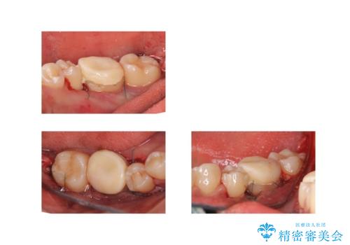 奥歯の高さがない　歯周外科処置で解決　(クラウンレングスニング)の治療中