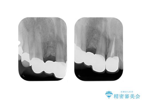 前歯をやむなく抜歯　ブリッジに　治療ついでに歯並びもよくの治療後