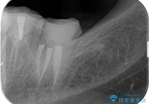割れたクラウン 再発した虫歯の治療の治療中