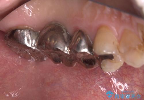 【セラミッククラウン】【ブリッジ】奥歯の奥側からよく汚れが出てくるの治療前