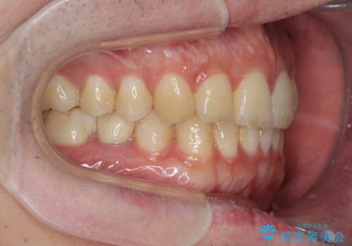 前歯のがたつきをなおしたい マウスピース矯正の治療後