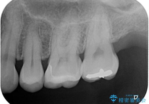 詰め物と歯の境目に汚れが溜まるの治療後