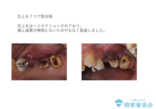 全体をきちんと治したいの治療中