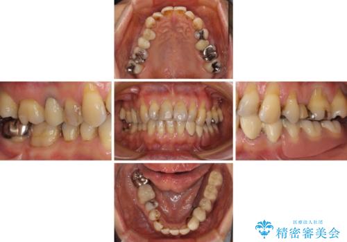 入れ歯を使いたくない 細い骨にインプラントを埋入した補綴治療の治療前