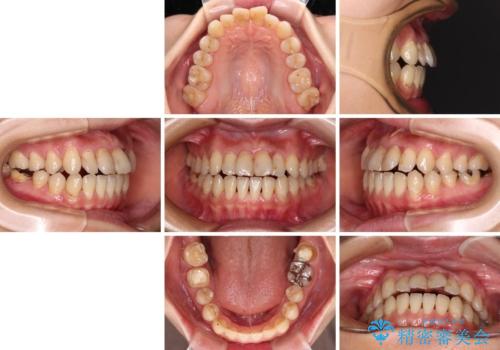 【モニター】開咬を治したい インビザラインによる矯正治療の治療前
