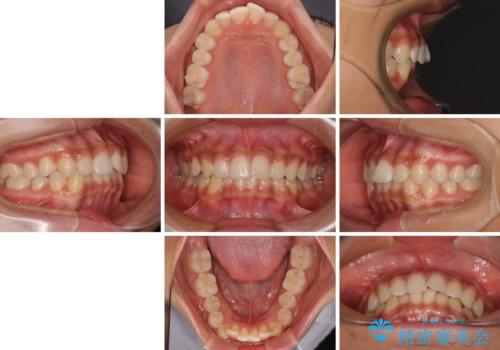 前歯のデコボコを治したい インビザライン・モデレートによる矯正治療の治療前