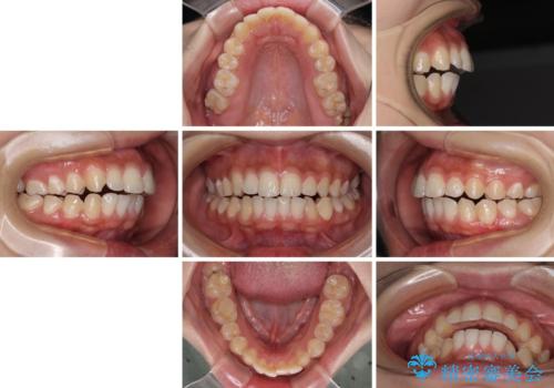 前に出ている上顎 抜歯矯正で唇を閉じやすくの治療前