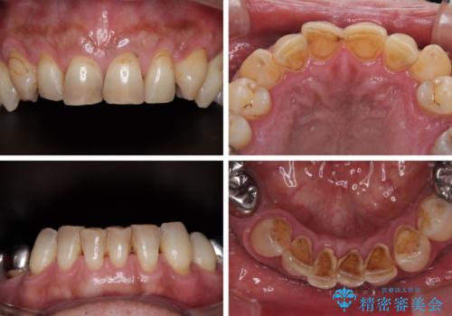 黄ばんだ前歯をきれいに 前歯の審美歯科治療の治療前