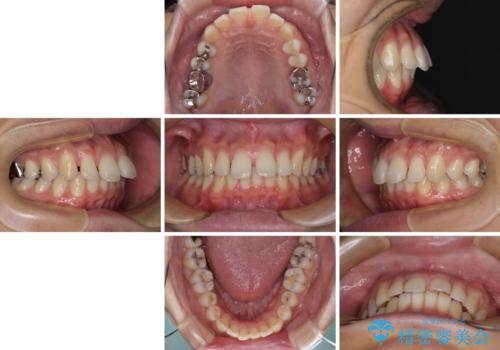 深い咬み合わせと前歯の隙間　ハーフリンガルによる矯正治療の治療前