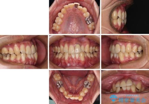抜歯矯正で八重歯を改善　インビザライン矯正治療の治療前