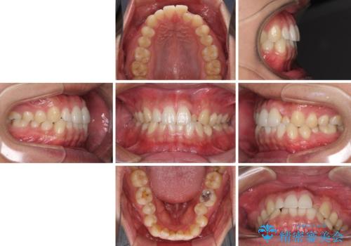 前歯のデコボコとクロスバイト インビザライン矯正治療の治療前