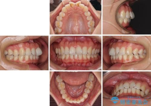 捻れた前歯をインビザラインで整えるの治療前