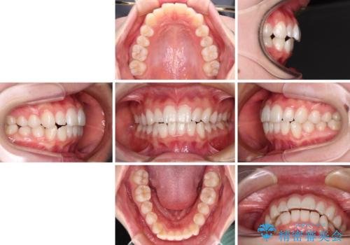 【モニター】口が閉じにくい 膨らんだ口元を抜歯矯正ですっきりとの治療前