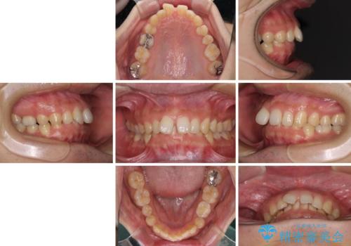 【モニター】前歯に隙間ができるほどのディープバイト ワイヤー装置で負担の少ない咬み合わせにの治療前