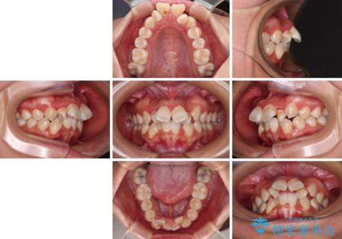 唇からはみ出るほど飛び出した前歯 ワイヤー装置による抜歯矯正の治療前