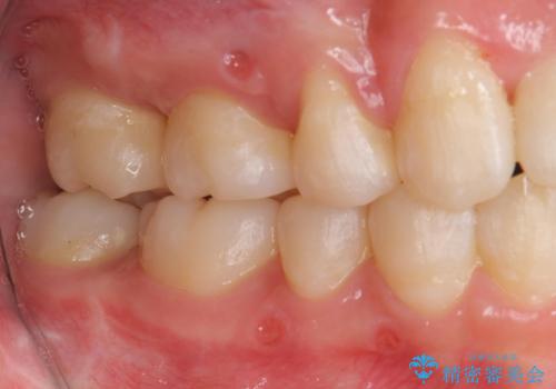 難症例 奥歯がかみ合っていない 歯並び矯正で別人にの治療後