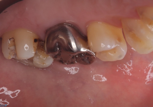 フロス通したら詰め物が取れたの治療前